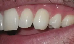 Thumbnail control image for Close-up of a person's dental health, highlighting teeth with varying conditions and their alignment.