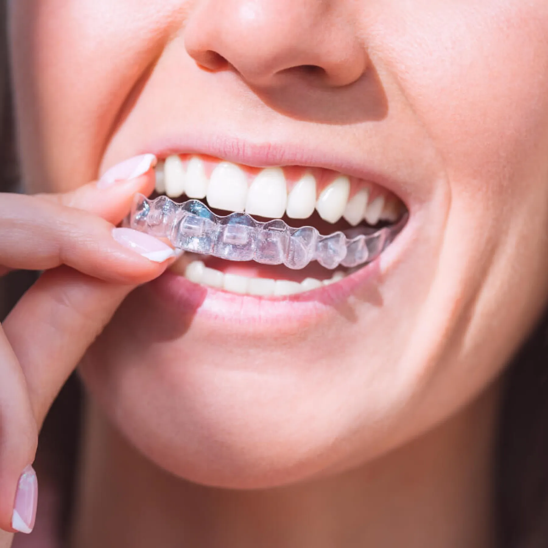 A smiling woman placing a clear dental aligner in her mouth, showcasing her bright teeth.