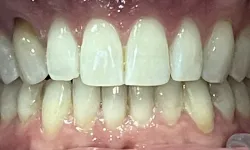 Thumbnail control image for a close-up of a person's mouth